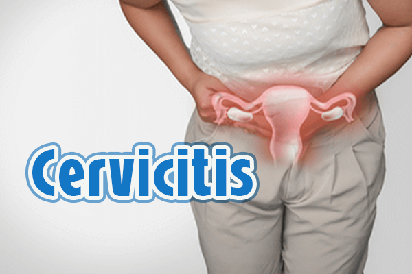 Cervicitis Síntomas Causas Diagnóstico Y Tratamiento Clínica Familiar San Rafael De Bellaire 5401