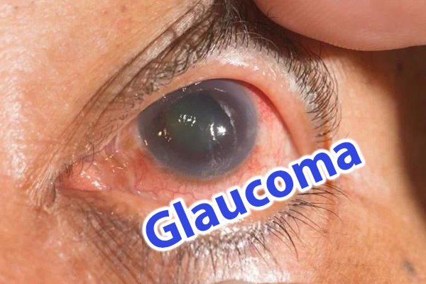 ¿Qué es el glaucoma?