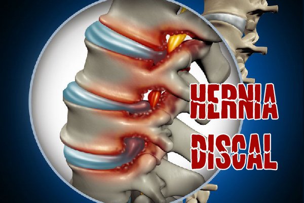 ¿Qué es la hernia discal?