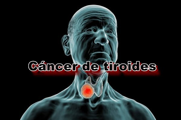 ¿Qué es el cáncer de tiroides?