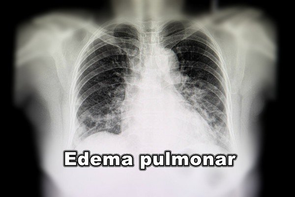 Edema pulmonar