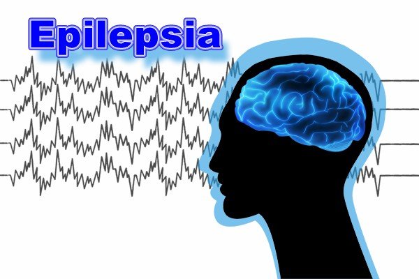 Epilepsia