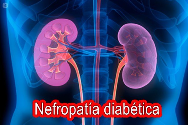 Nefropatía diabética