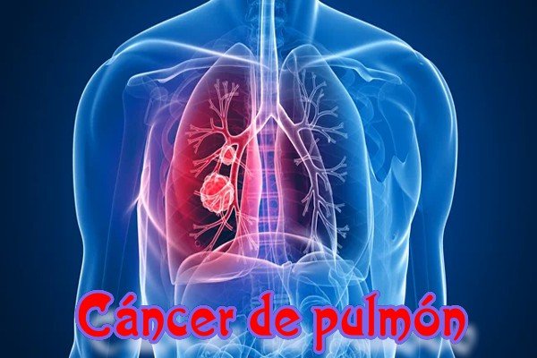 ¿Qué es el cáncer de pulmón?