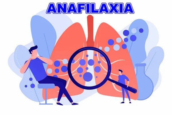¿Qué es la anafilaxia?