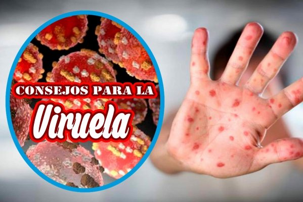 Consejos para la viruela