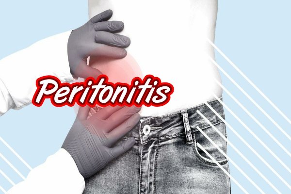 ¿Qué es la peritonitis?