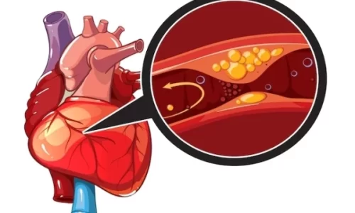 Cardiopatía Isquemia